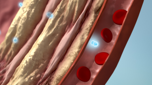 IPF alveoli featured IPF alveoli featured