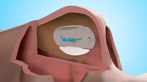 Nose Stent Surgical Animation - Lumen3D