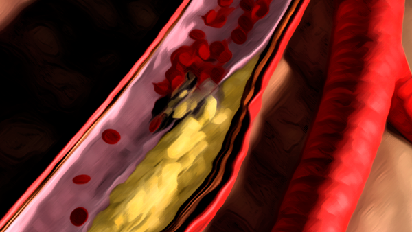 angina paint style 1 angina paint style 1
