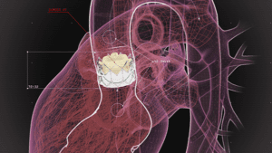 technical illustration heart valve featured
