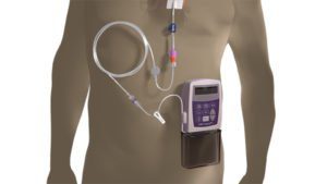 intravenous pump