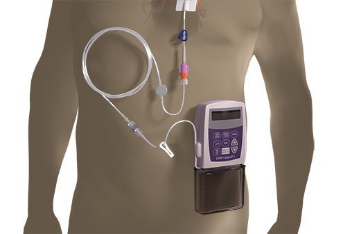 intravenous pump