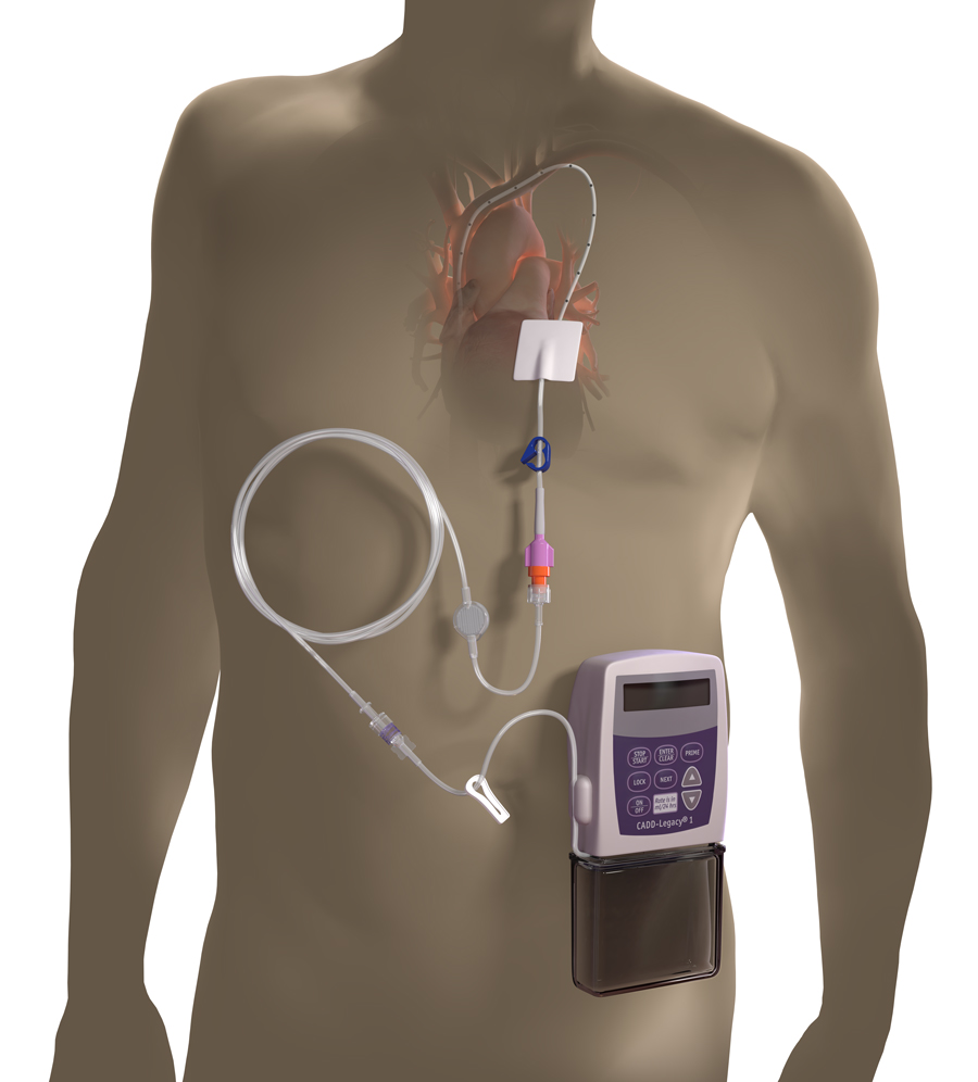 intravenous-pump