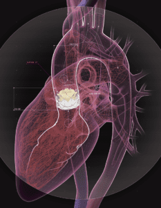 technical illustration heart valve