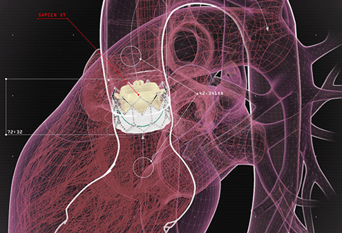 technical illustration heart valve featured