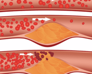 angina blockage diagram