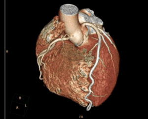 angina cornary CT scan
