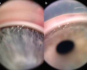 trabecular meshwork images reference